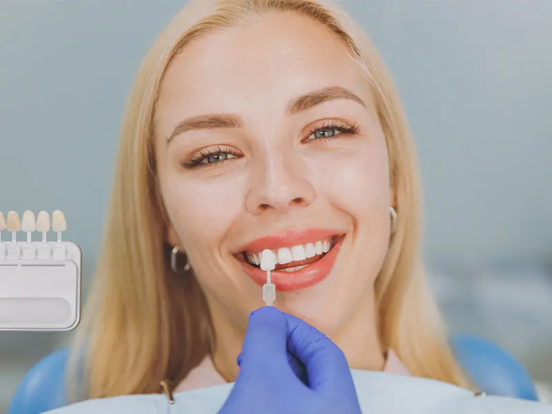 Genzano - Faccette dentali