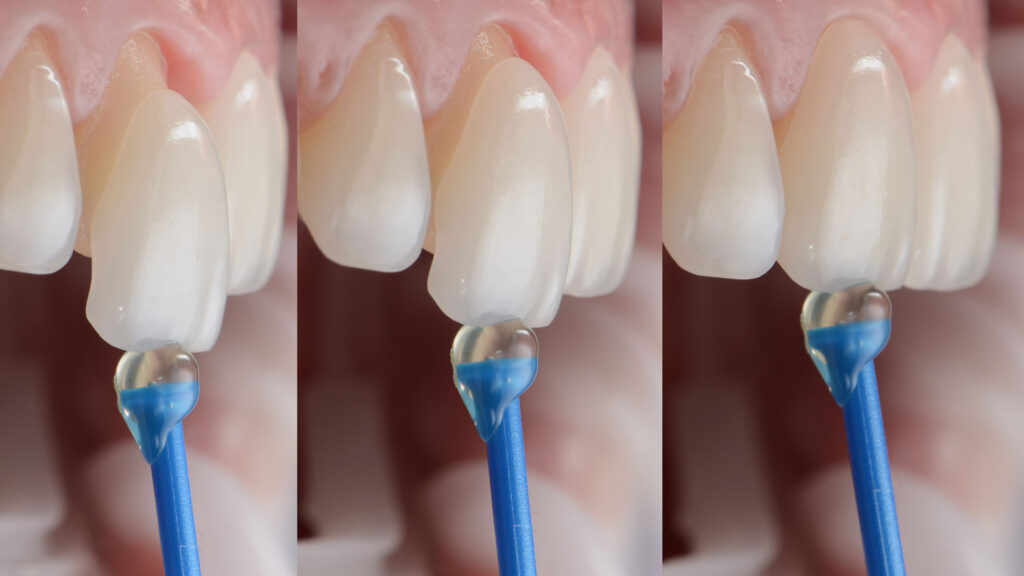 Faccette dentali - Genzano